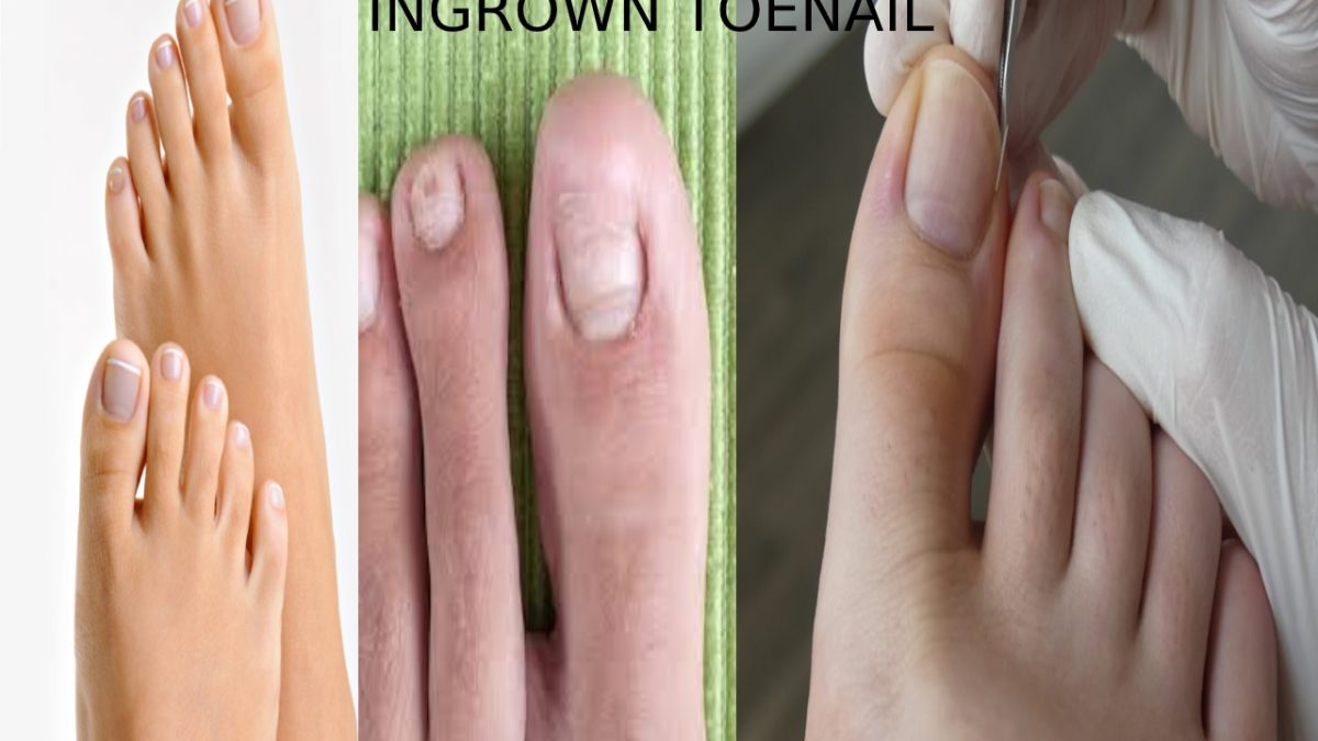 Ingrown Toenails -Explaining, Likely, Symptoms and Causes, And More
