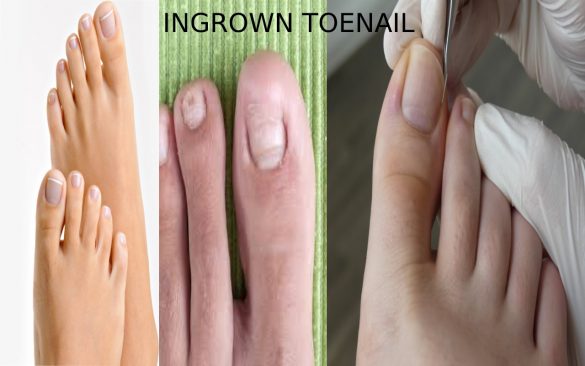 Ingrown Nail