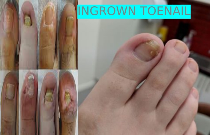 Ingrown Nail