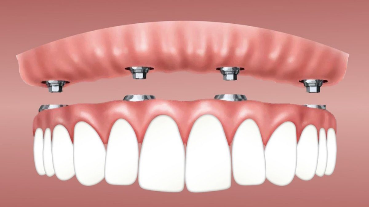 Some Amazing Benefits of All-on-Four Dental Implants