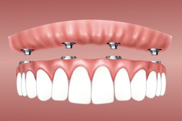 Some Amazing Benefits of All-on-Four Dental Implants