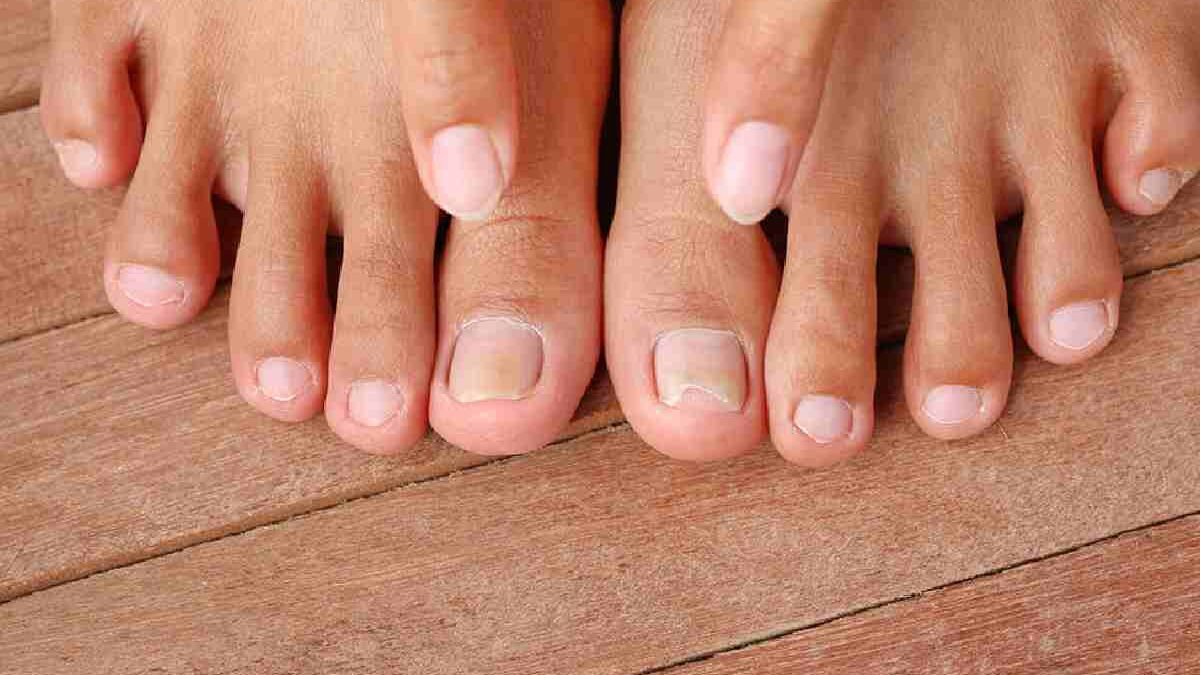 Ingrown Toenails -Explaining, Likely, Symptoms and Causes, And More