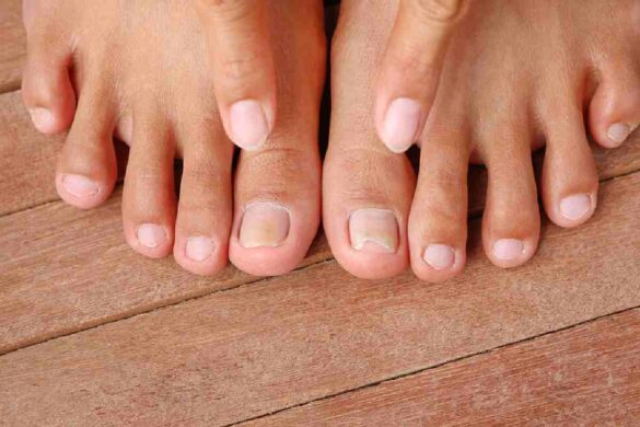Ingrown Toenails